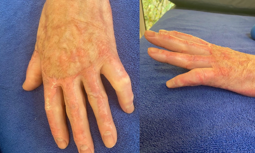 Hand scar after Scarwork