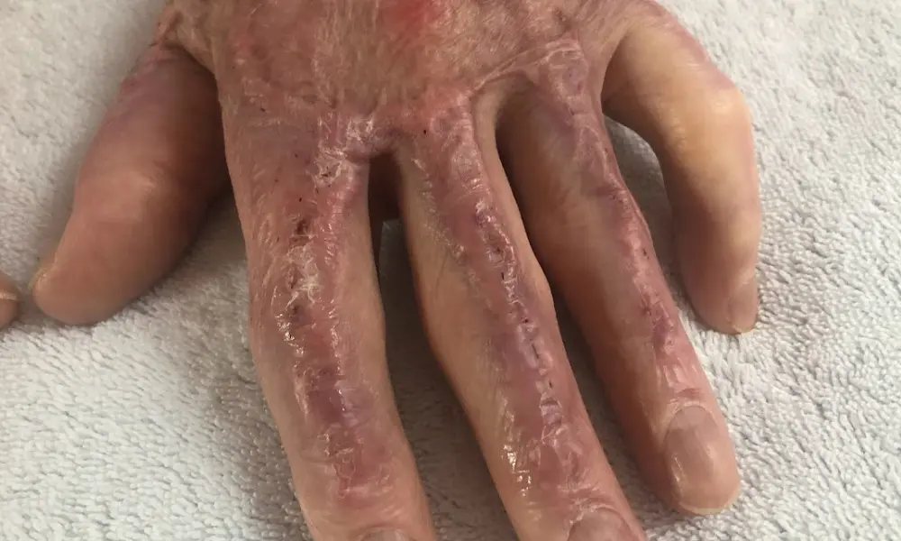 Hand scar before ScarWork