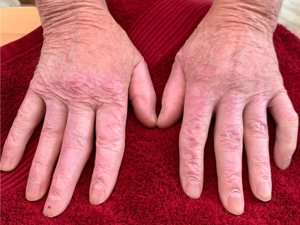 ScarWork After - Both Hands
