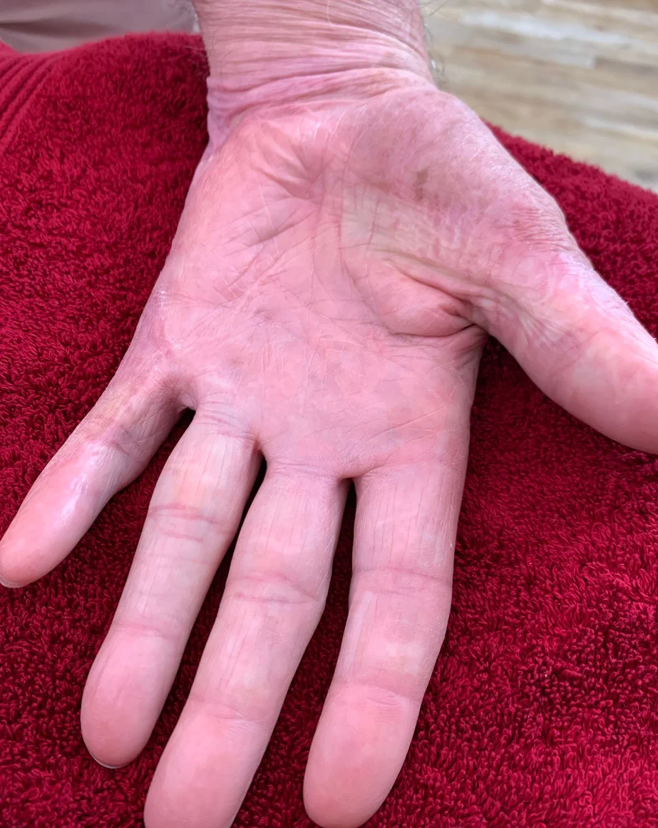 ScarWork After - Left Hand Palm