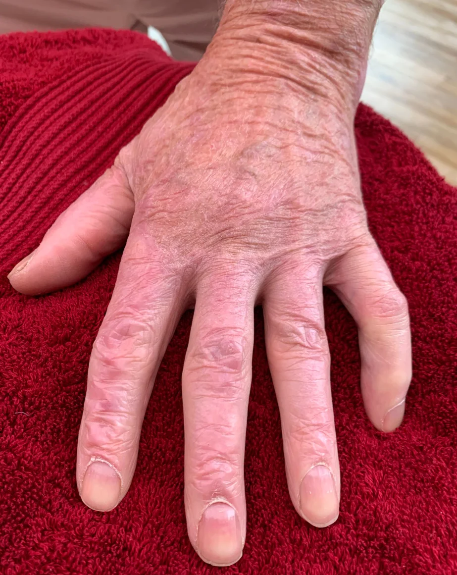 ScarWork - After Left Hand