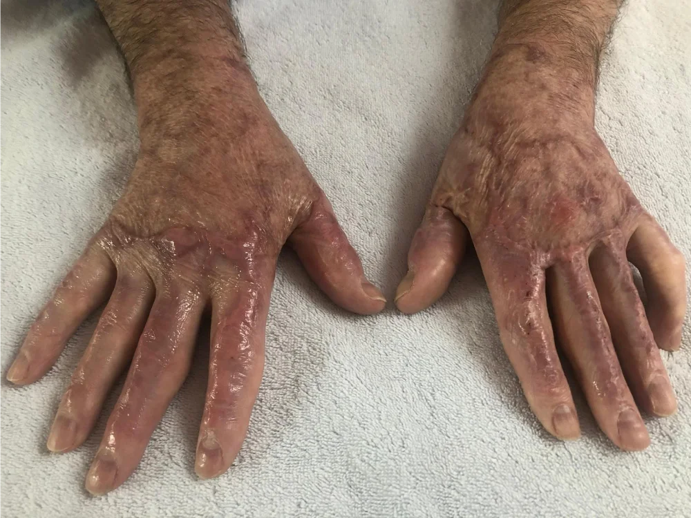 ScarWork Before - Both Hands