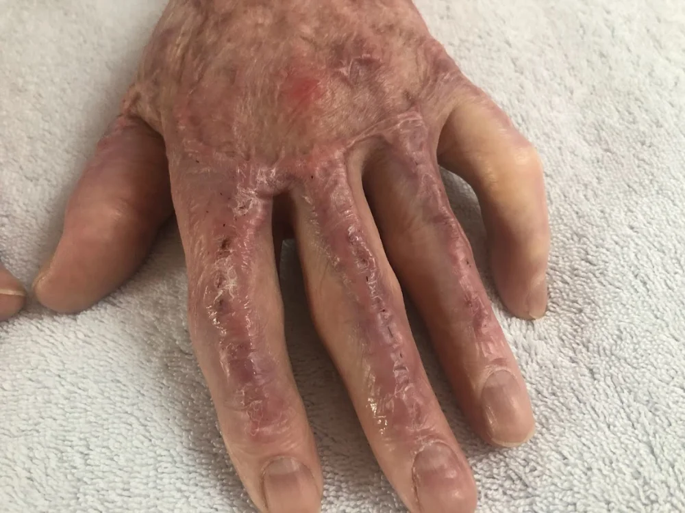 ScarWork Before - Left Hand